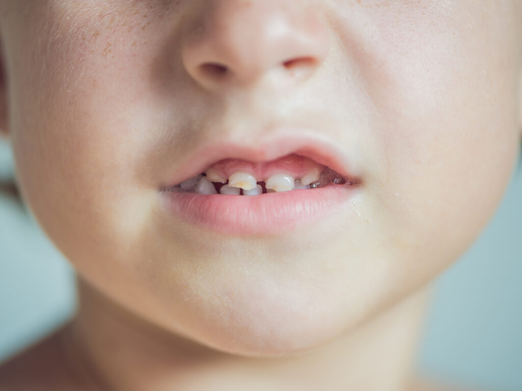 macchie denti bambini